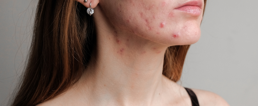 Brotes por maquillaje: cómo identificar gatillos sin satanizarlo