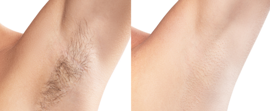 ¿Cómo evitar los vellos enterrados y la irritación después de depilarme?