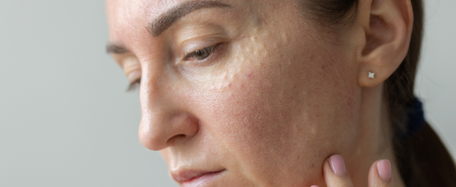 ¿La skincare coreana puede causar sarpullido en la piel?