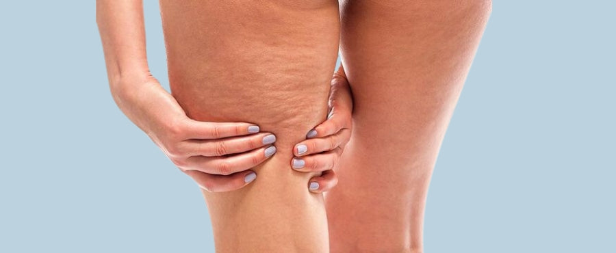 celulitis en las piernas